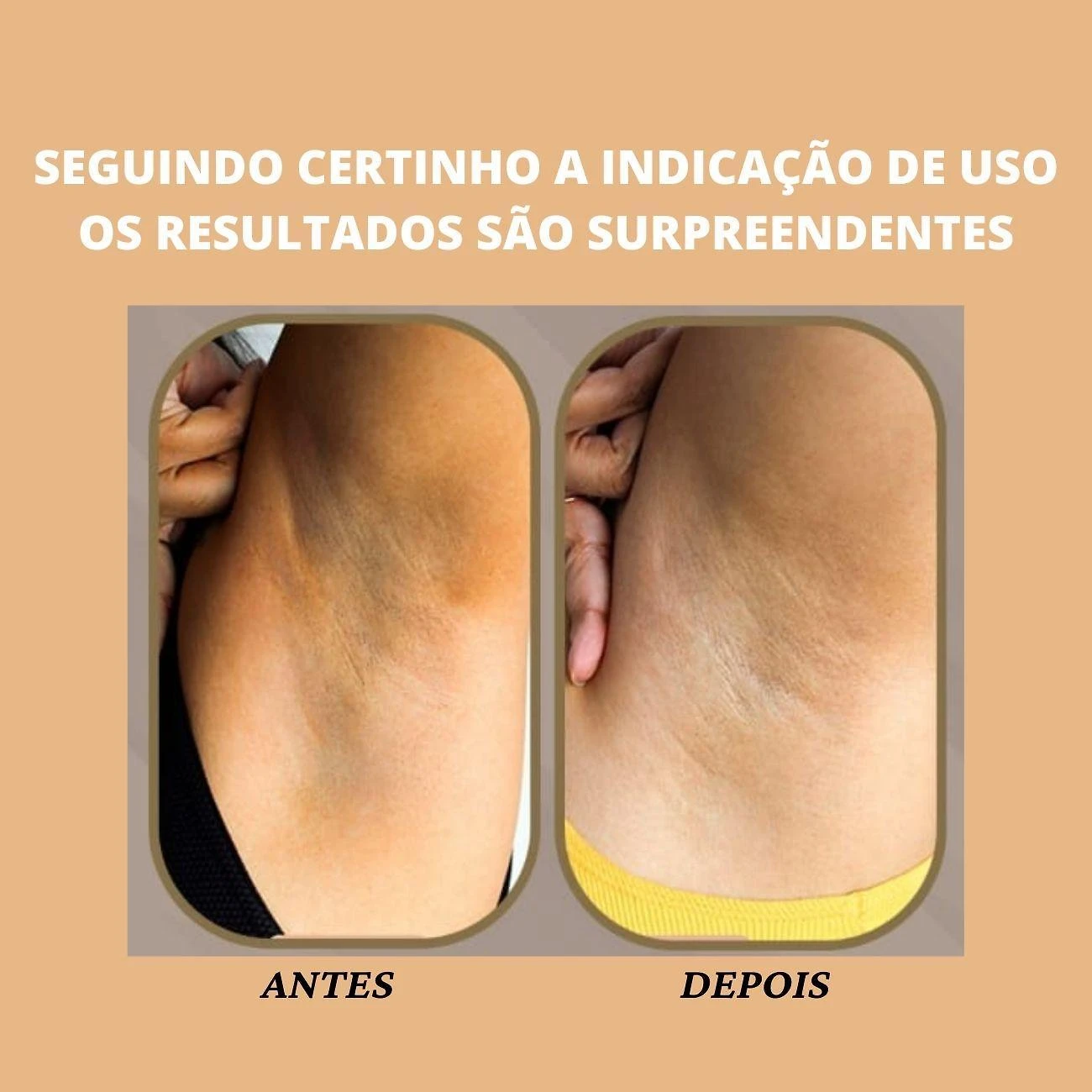 Miniatura Clareamento De Pele Íntima Virilha Axila E Entre Coxa Lisa